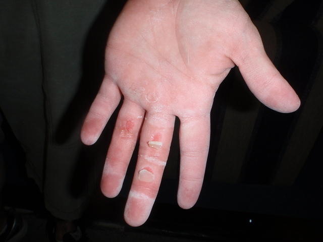 2009_0422NJRocksJessesBattleWounds.JPG