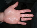 2009_0423JessesHandTheNextDay.jpg