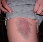 2002_0211My BooBoo1DayLater